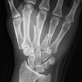 Wrist hand fracture image